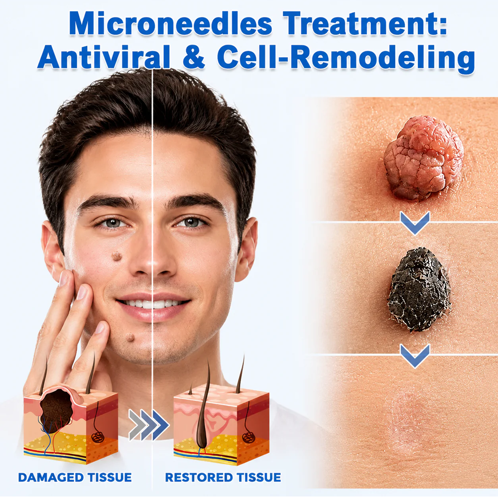 2版✨Hiskin ® 2-in-1 Microneedle & Hydrocolloid Patch🍀 | Removes raised moles, acne, flat warts, and skin tags | Helps improve wrinkles, scars, and blemishes | Invisible patches for face and body