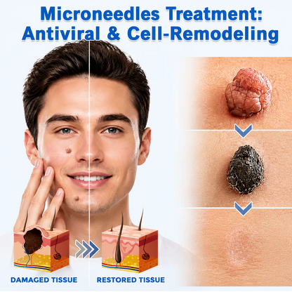 2版✨Hiskin ® 2-in-1 Microneedle & Hydrocolloid Patch🍀 | Removes raised moles, acne, flat warts, and skin tags | Helps improve wrinkles, scars, and blemishes | Invisible patches for face and body