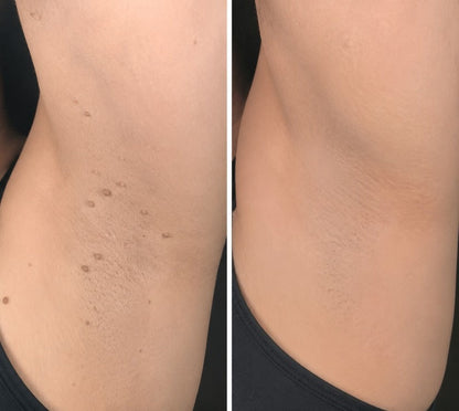 2版✨Hiskin ® 2-in-1 Microneedle & Hydrocolloid Patch🍀 | Removes raised moles, acne, flat warts, and skin tags | Helps improve wrinkles, scars, and blemishes | Invisible patches for face and body