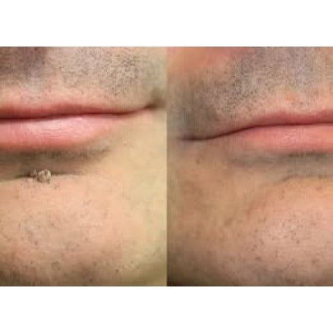 2版✨Hiskin ® 2-in-1 Microneedle & Hydrocolloid Patch🍀 | Removes raised moles, acne, flat warts, and skin tags | Helps improve wrinkles, scars, and blemishes | Invisible patches for face and body