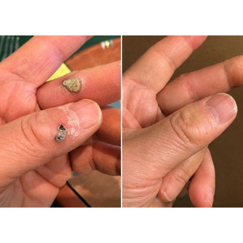 2版✨Hiskin ® 2-in-1 Microneedle & Hydrocolloid Patch🍀 | Removes raised moles, acne, flat warts, and skin tags | Helps improve wrinkles, scars, and blemishes | Invisible patches for face and body