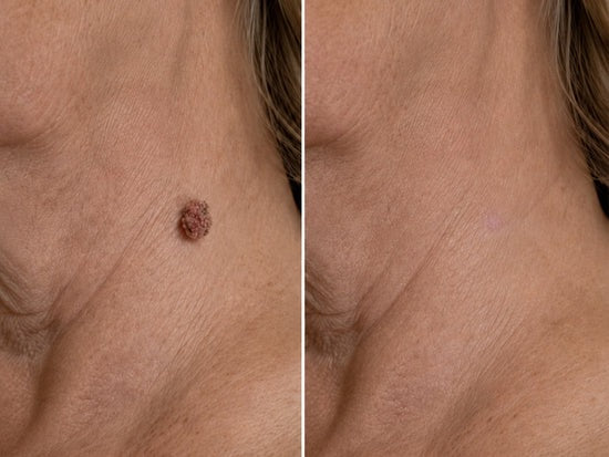 2版✨Hiskin ® 2-in-1 Microneedle & Hydrocolloid Patch🍀 | Removes raised moles, acne, flat warts, and skin tags | Helps improve wrinkles, scars, and blemishes | Invisible patches for face and body