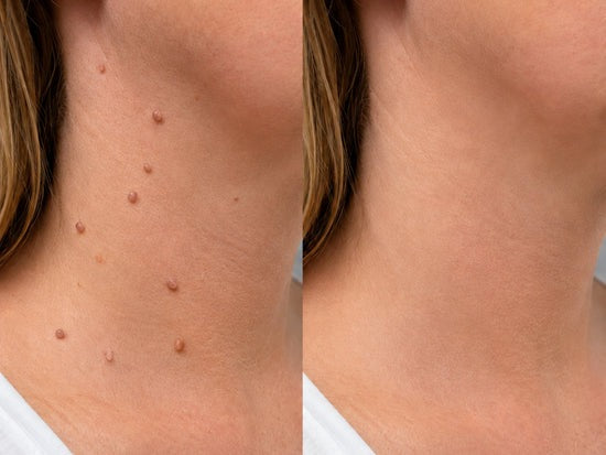 2版✨Hiskin ® 2-in-1 Microneedle & Hydrocolloid Patch🍀 | Removes raised moles, acne, flat warts, and skin tags | Helps improve wrinkles, scars, and blemishes | Invisible patches for face and body