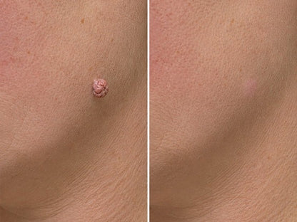 2版✨Hiskin ® 2-in-1 Microneedle & Hydrocolloid Patch🍀 | Removes raised moles, acne, flat warts, and skin tags | Helps improve wrinkles, scars, and blemishes | Invisible patches for face and body